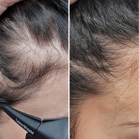 Курс лазерной стимуляции роста волос на аппарате М22 Resur Fx - фото результаты лечения