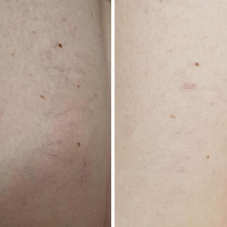 Лазерное удаление сосудов в области голени - фото результаты лечения