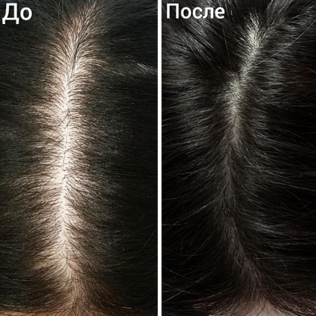 Курс плазмотерапии для восстановления волос CORTEXIL PRP - фото результаты лечения