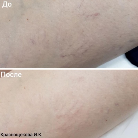 Удаление сосудов в области голени на аппарате М22 - фото результаты лечения